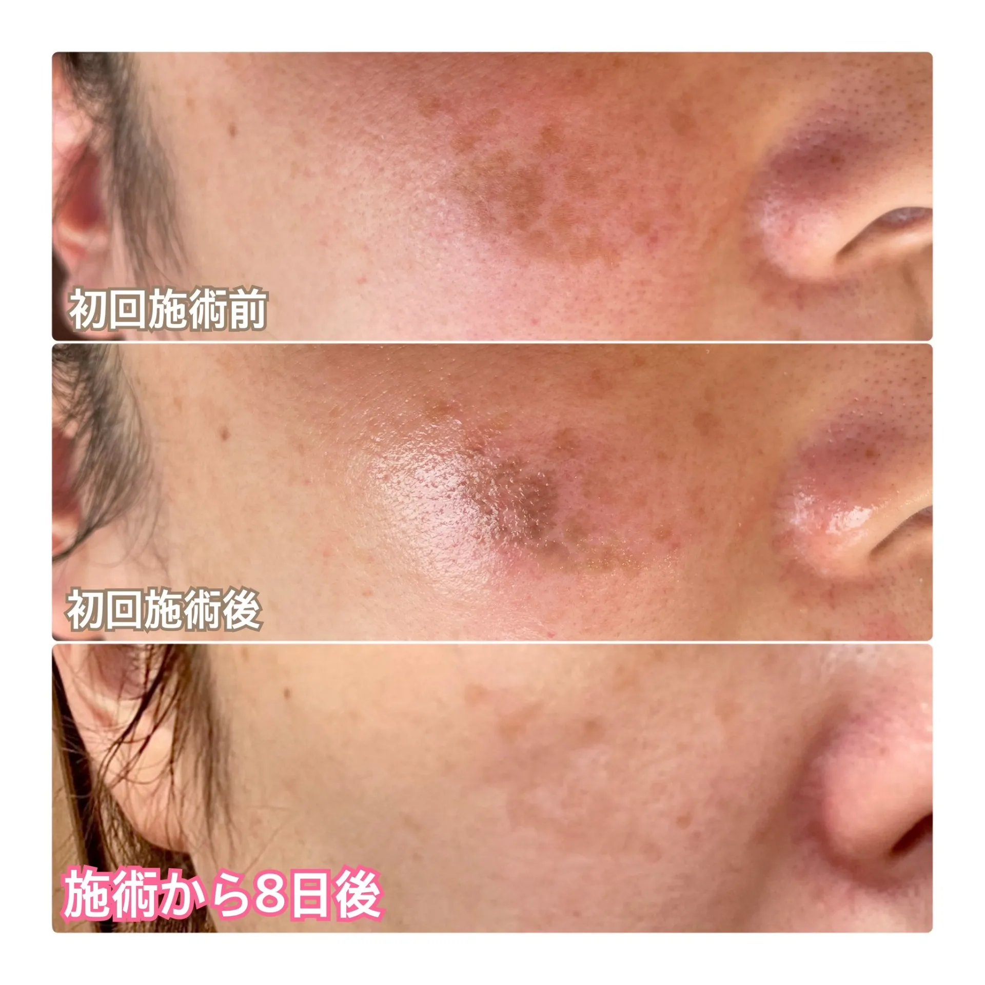 大阪/貝塚【muumo】泉州初！本格シミケア