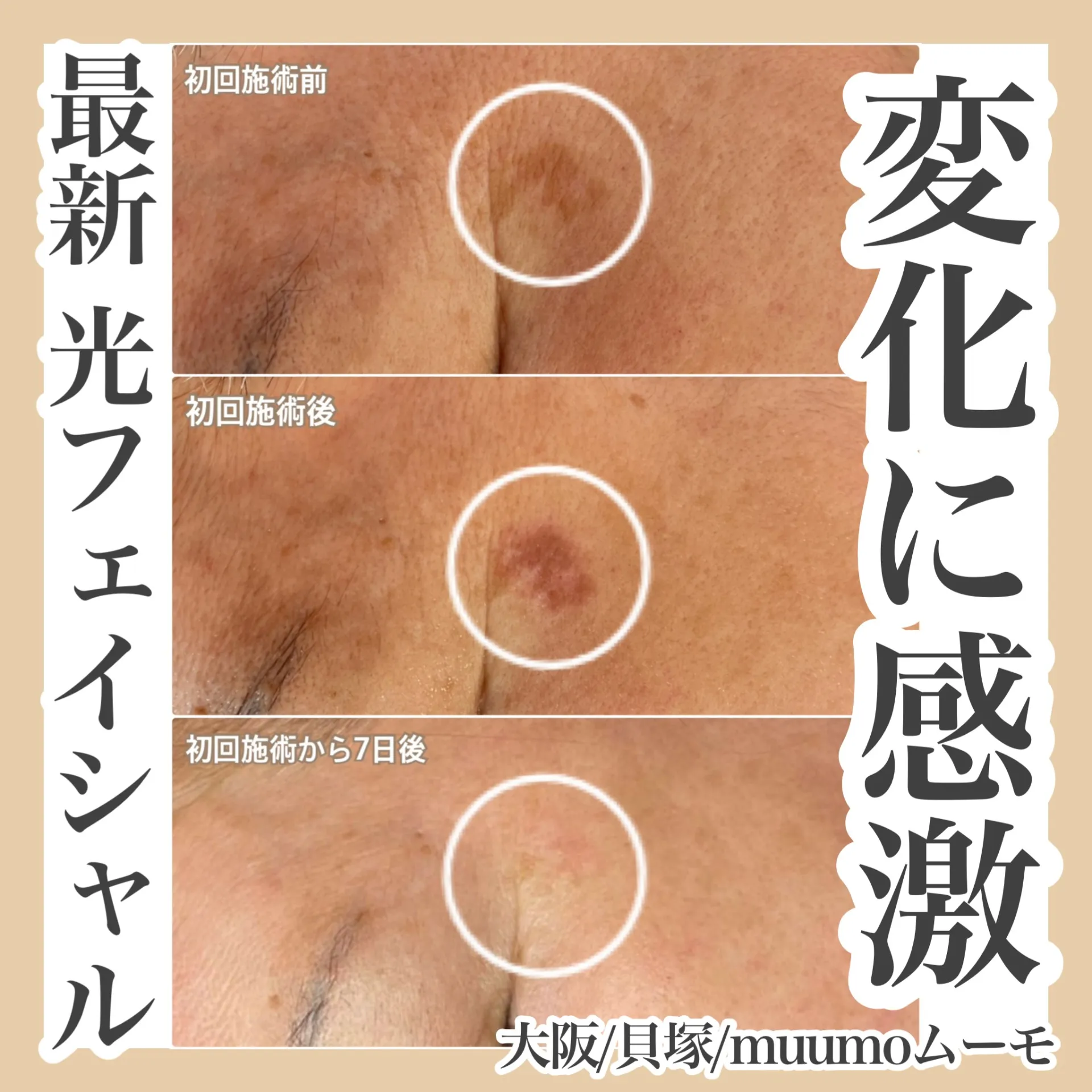 大阪/貝塚【muumo】シミのお悩み改善します