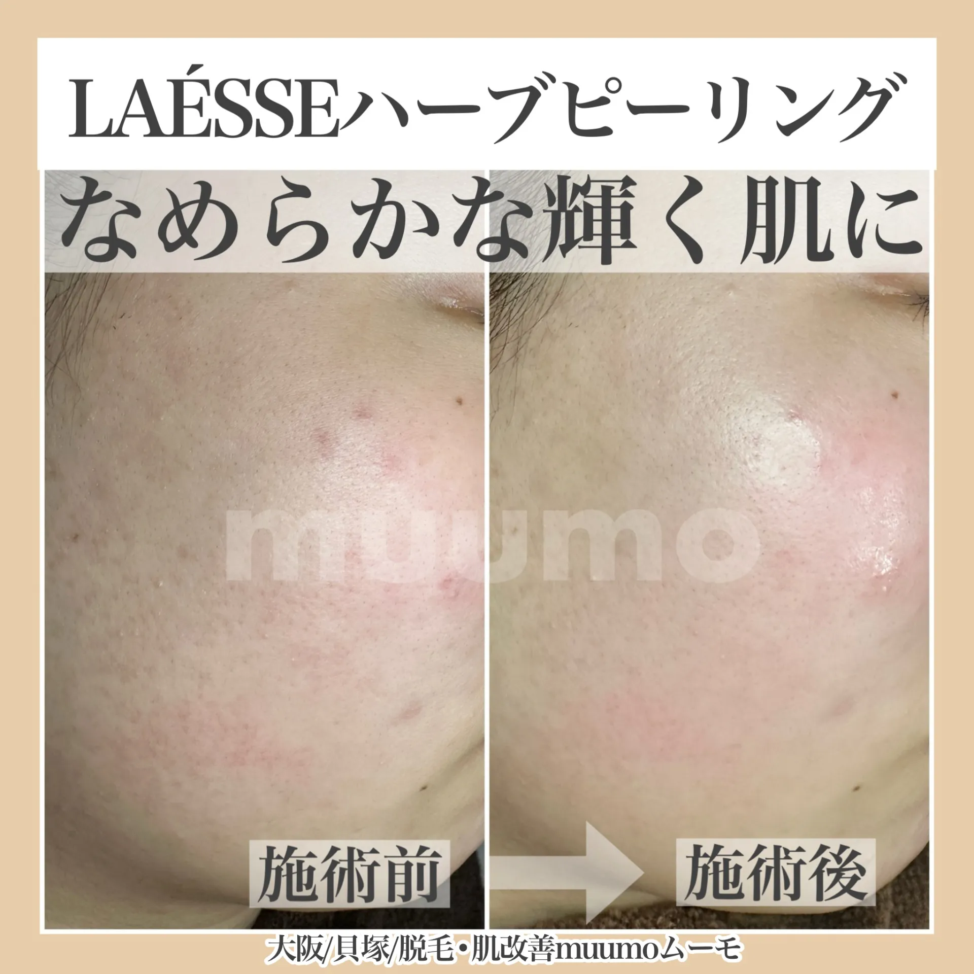 大阪/貝塚【muumo】次世代ハーブピーリングで輝く肌に