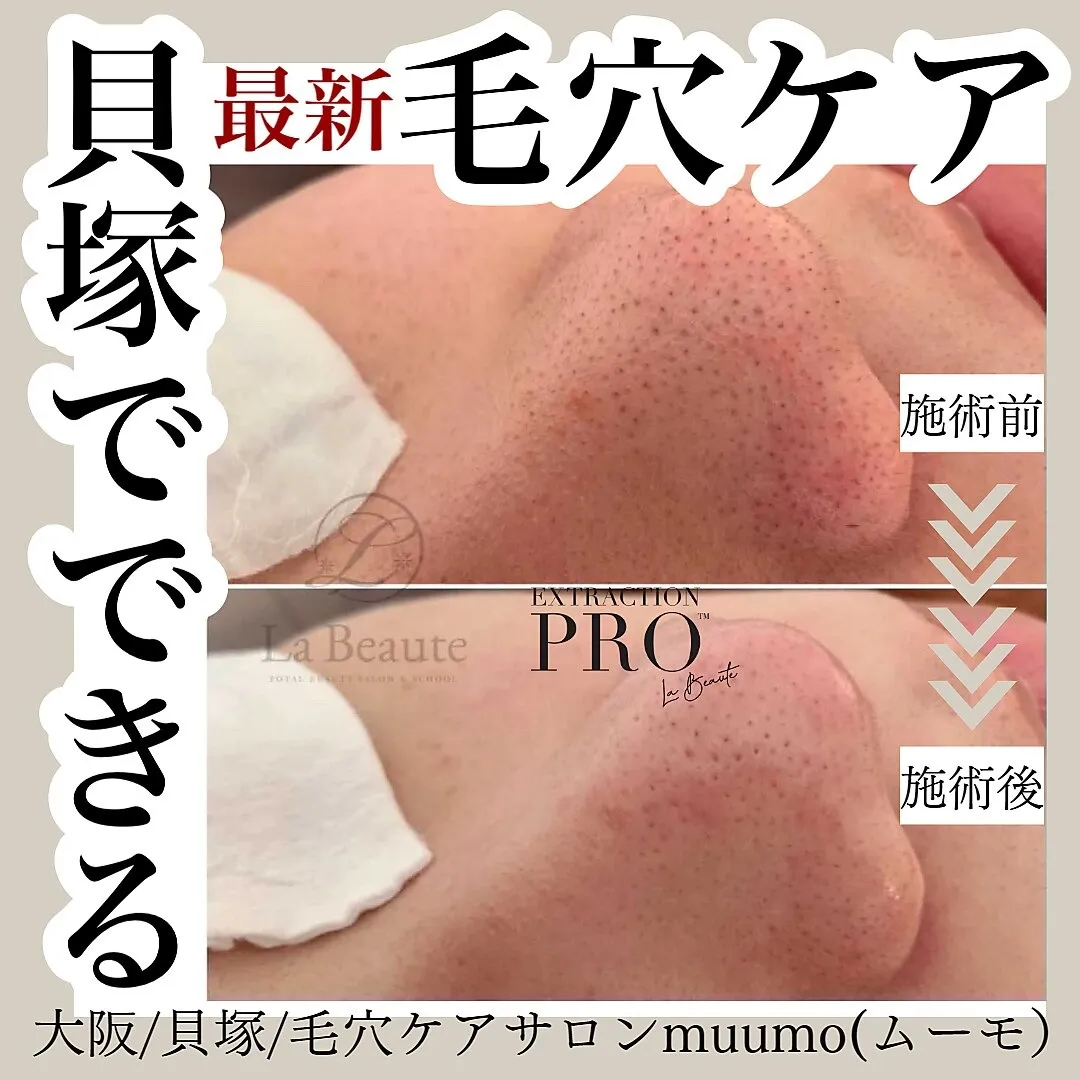 毛穴のお悩みお任せください！