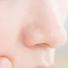 毛穴